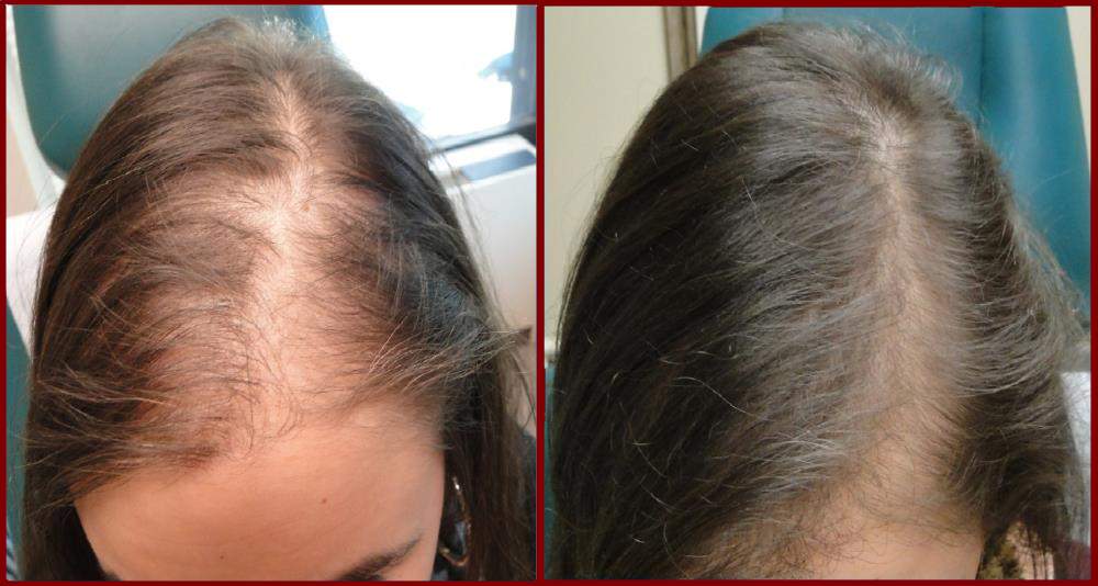 PRP Female Hair Restoration Results
