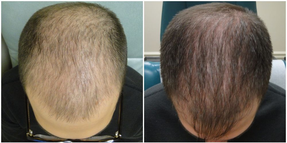 PRP Male Hair Restoration Results