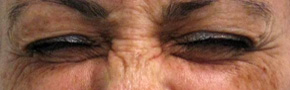 Botox Crows Feet Injections