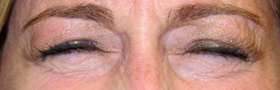 Botox Crows Feet Injections