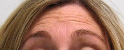 Botox Forehead Injections