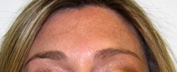 Botox Forehead Injections